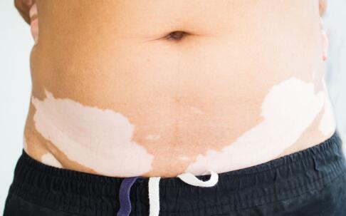 南通白癜风复发的原因主要是什么